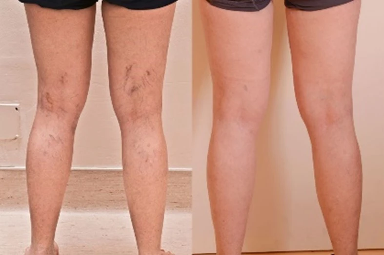 spider vein laser treatment result in las vegas rejuv lv wellness nv