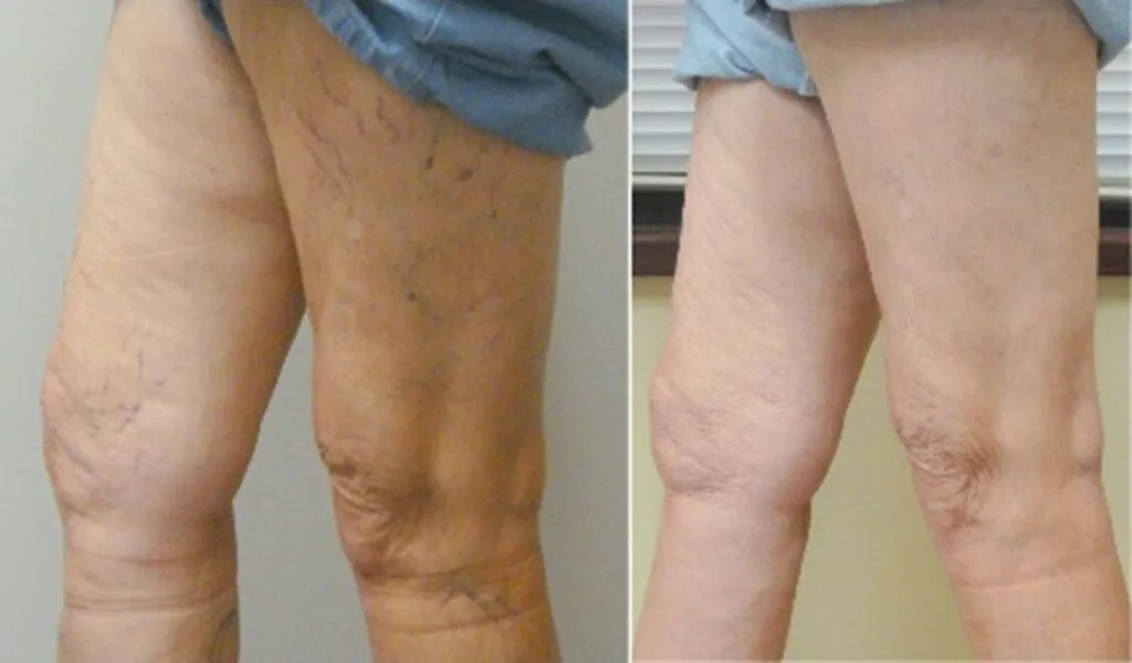 spider vein laser treatment results in rejuv lv wellness las vegas nv