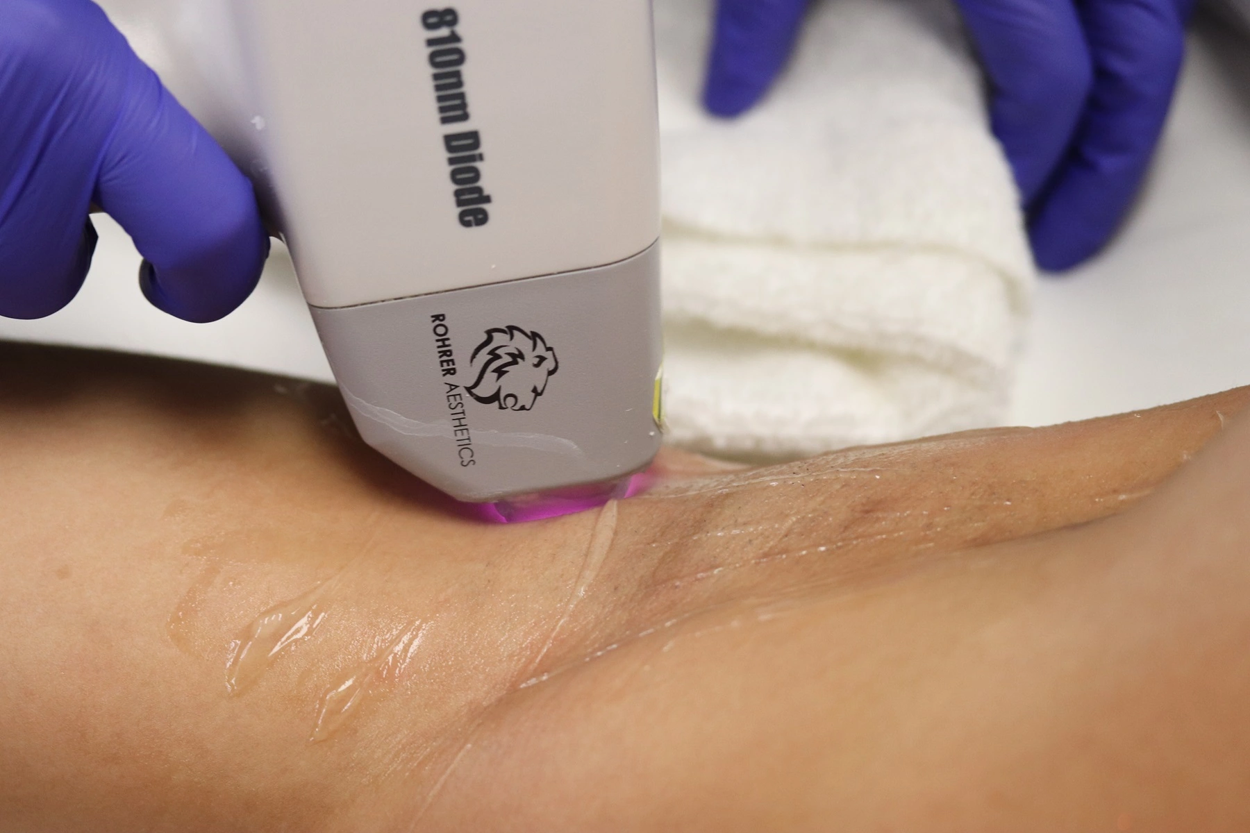 Laser Hair Removal in Las Vegas NV RejuvLV Wellness