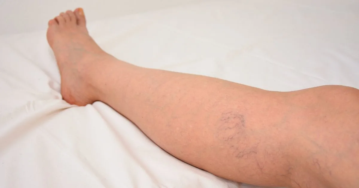 Red and purple thread-like spider veins on the leg caused by weakened blood vessel valves.