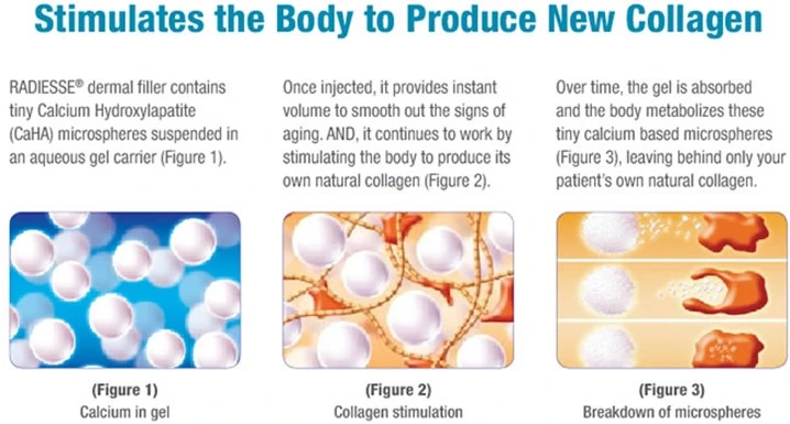 Radiesse process inforgraphic image | RejuvLV Wellness & Aesthetics | Las Vegas, NV