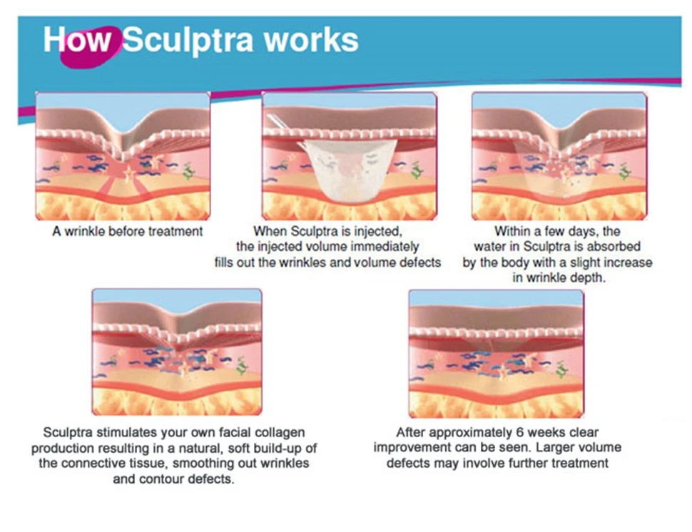 How sculptra works infographic image | RejuvLV Wellness & Aesthetics | Las Vegas, NV