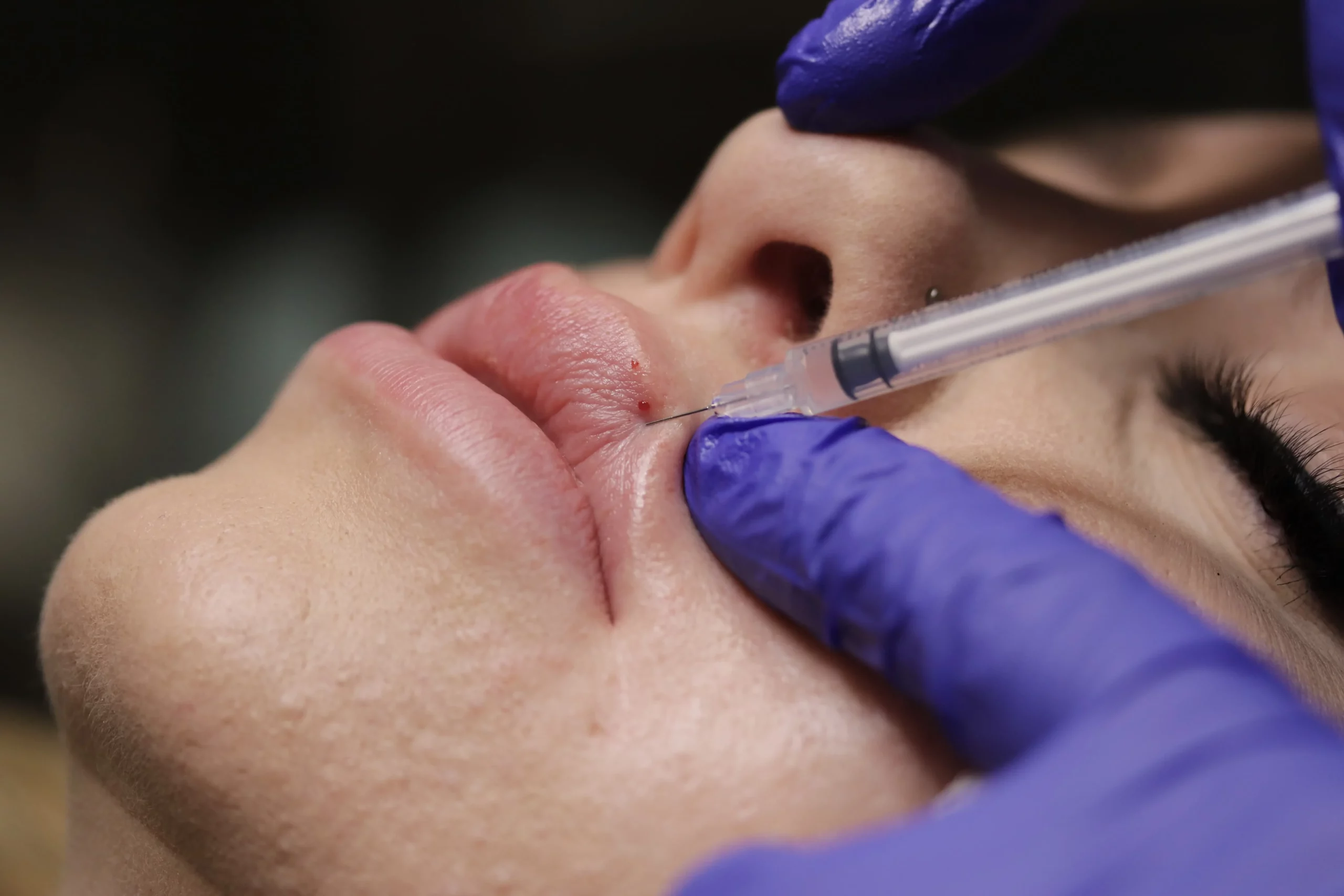 dermal fillers injected on lips | RejuvLV Wellness & Aesthetics | Las Vegas, NV