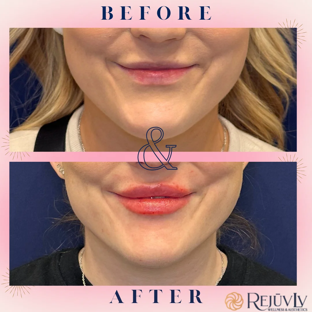 Before and After photo | Filler treatment for lips | RejuvLV Wellness & Aesthetics | Las Vegas, NV